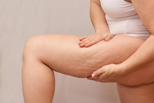 cellulite, falsa cellulite, pistola massaggiante per cellulite, pistola massaggiatrice per combattere le cellulite
